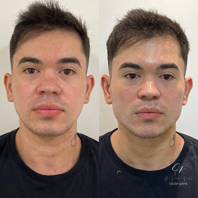 Harmonização Facial Full Face em São Paulo