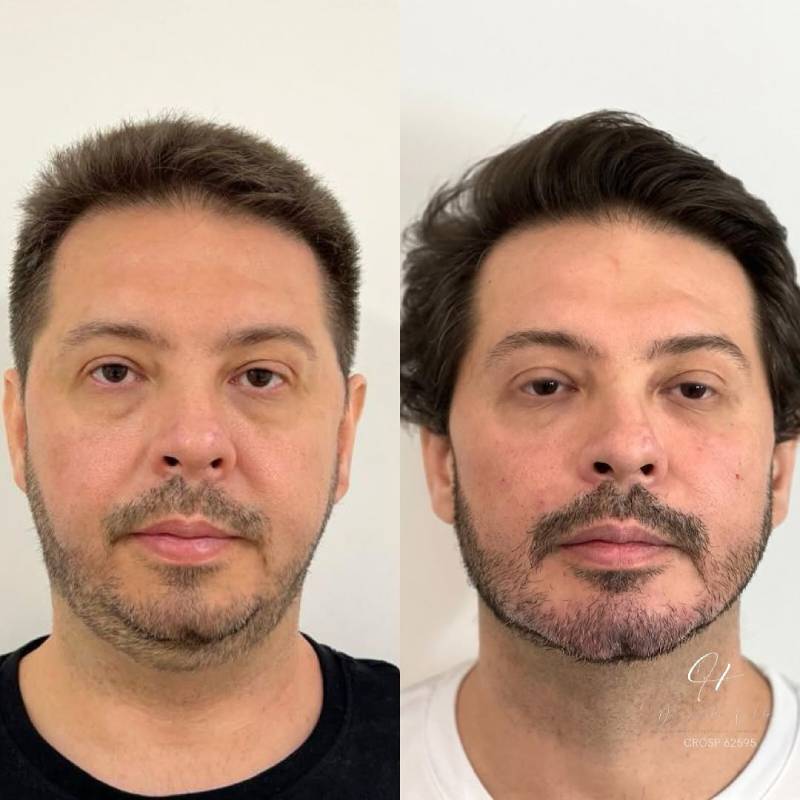 Harmonização Facial Full Face em São Paulo