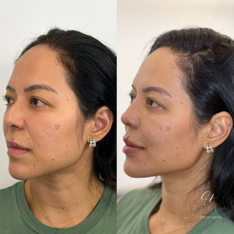 Harmonização Facial Full Face em São Paulo