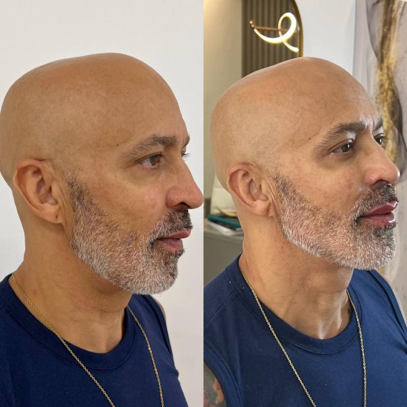 Harmonização Facial Full Face em São Paulo