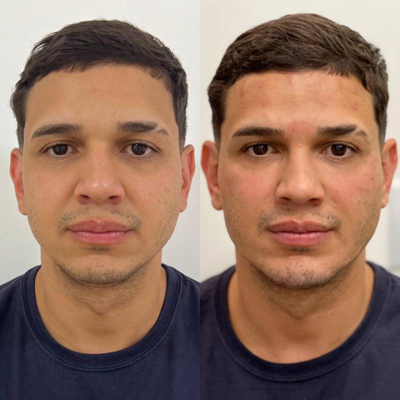 Harmonização Facial Full Face em São Paulo